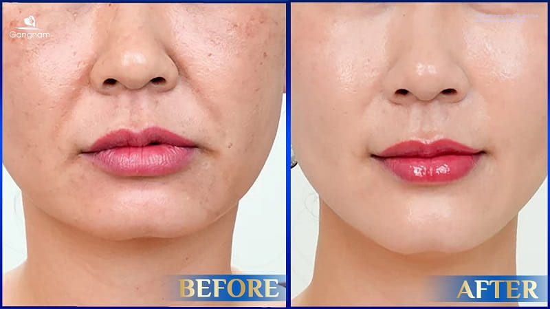 Tạo môi cười đẹp tự nhiên chỉ sau 30 phút 8 Tạo môi cười