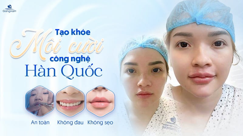 Tạo môi cười đẹp tự nhiên chỉ sau 30 phút 6 Tạo môi cười