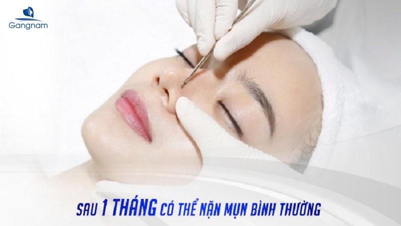 Nâng mũi có nặn mụn được không? 6 Nâng mũi có nặn mụn được không?
