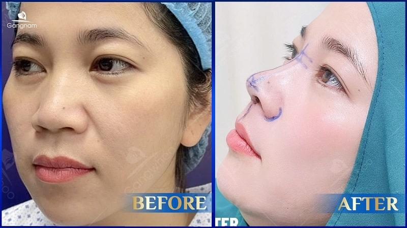 Nâng mũi có nặn mụn được không? 8 Nâng mũi có nặn mụn được không?