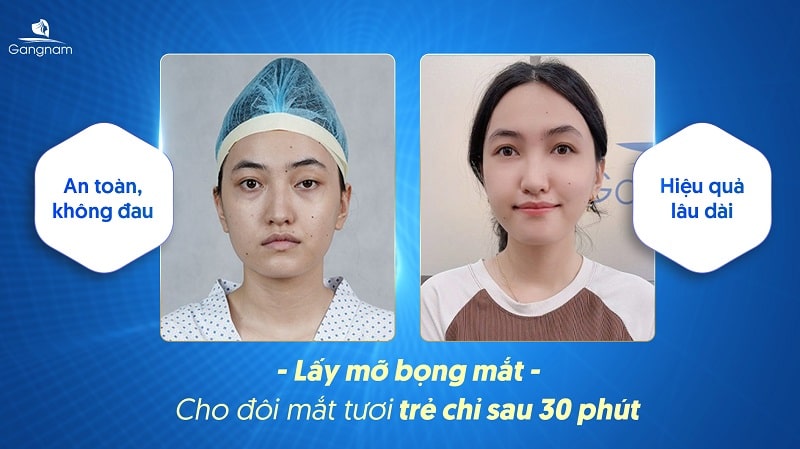 Lấy mỡ bọng mắt có bị lại không?