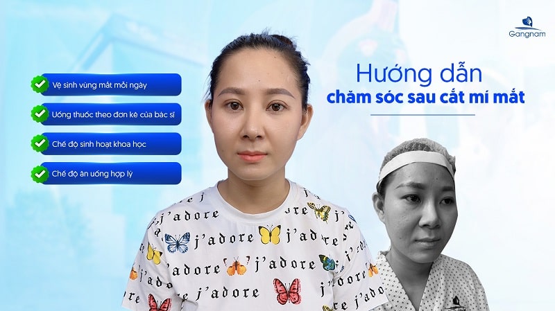 Cắt mí ăn xoài được không? 8 Cắt mí ăn xoài được không?