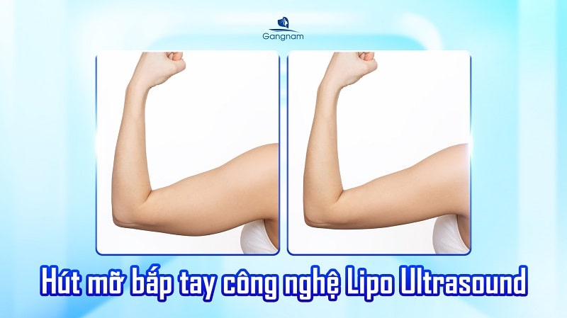 Hút mỡ bắp tay bị lồi lõm phải làm sao? 6 Hút mỡ bắp tay