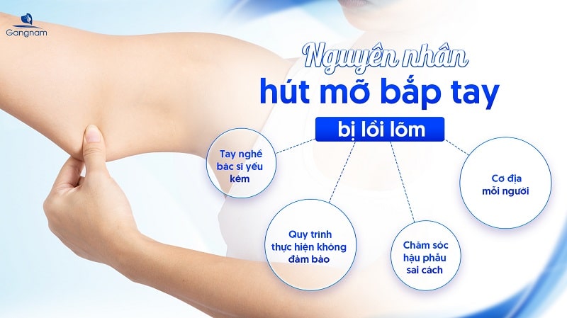 Hút mỡ bắp tay bị lồi lõm phải làm sao? 5 Hút mỡ bắp tay bị lồi lõm