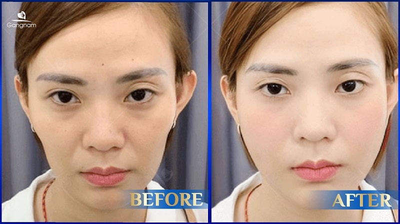 Tiêm má Baby bao nhiêu tiền? 8 Tiêm má Baby bao nhiêu tiền?