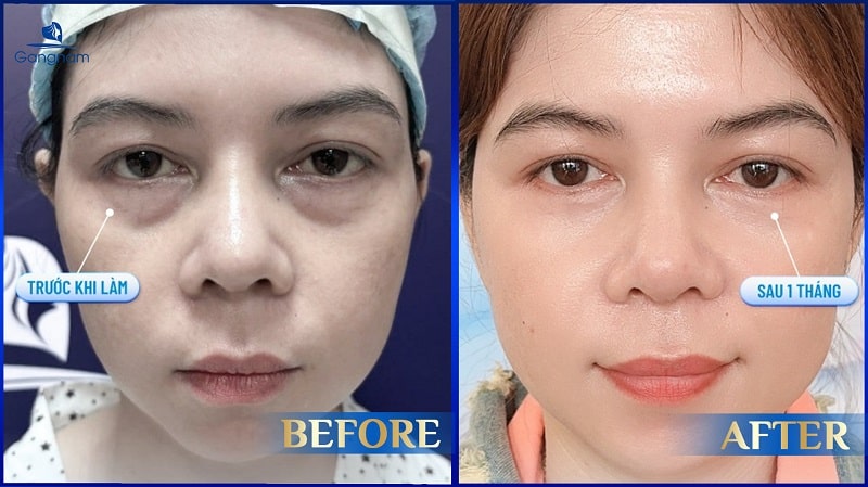 Cắt bọng mắt kiêng ăn gì? 6 Cắt bọng mắt kiêng ăn gì?