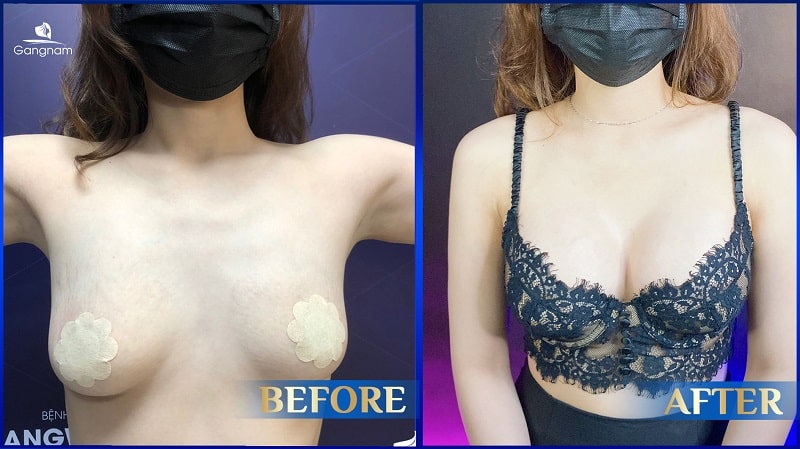 Nâng ngực xong có bị xệ không? 7 Nâng ngực xong có bị xệ không?