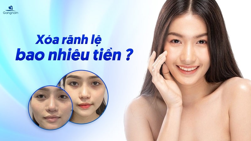 Xóa rãnh lệ bao nhiêu tiền? 5 Xóa rãnh lệ bao nhiêu tiền?