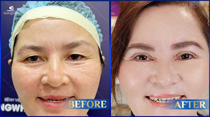 Xóa rãnh lệ bao nhiêu tiền? 8 Xóa rãnh lệ bao nhiêu tiền?