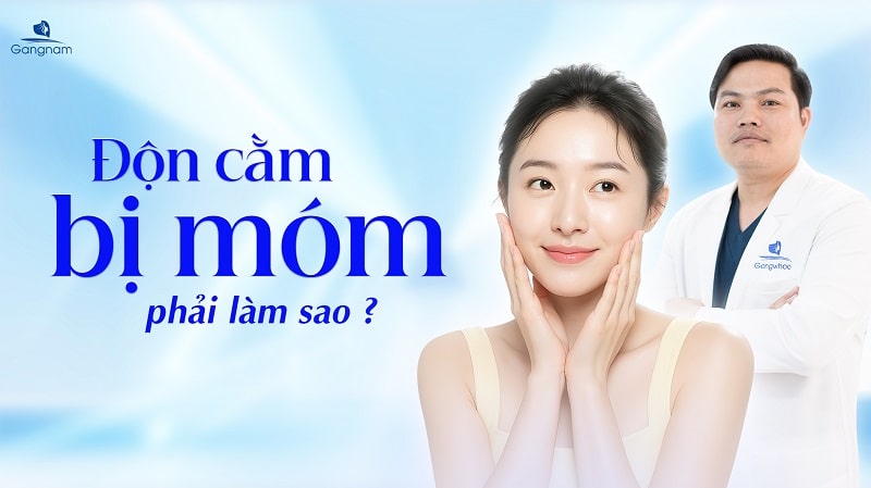 Độn cằm bị móm