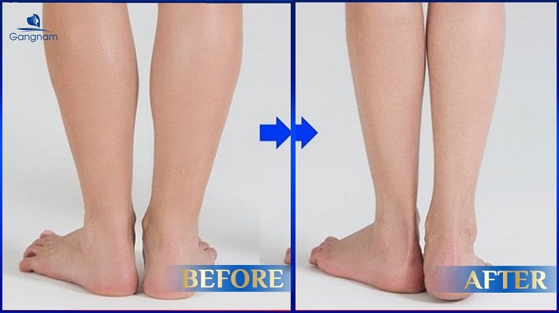 Có nên hút mỡ bắp chân không? 6 Hút mỡ bắp chân