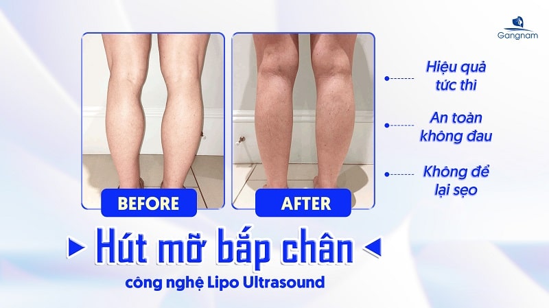 Có nên hút mỡ bắp chân không? 8 Hút mỡ bắp chân