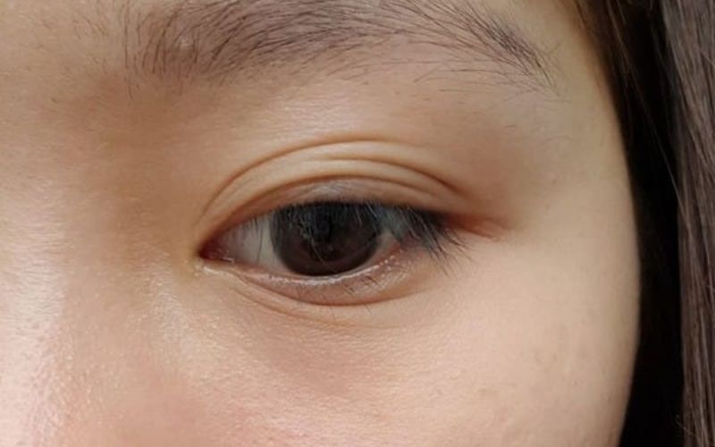 Mắt mí rưỡi là gì? Nguyên nhân và cách khắc phục hiệu quả 6 Mắt mí rưỡi