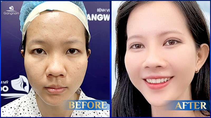 Mắt mí rưỡi là gì? Nguyên nhân và cách khắc phục hiệu quả 8 Mắt mí rưỡi