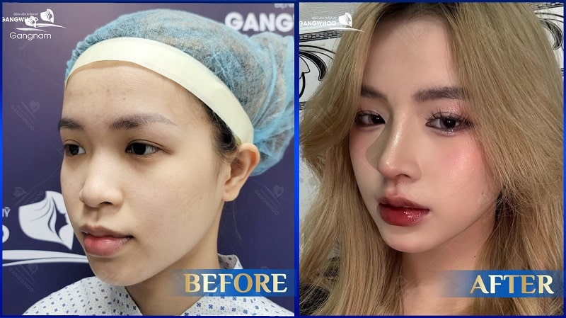 Nâng mũi về già có sao không? 6 Nâng mũi về già có sao không?
