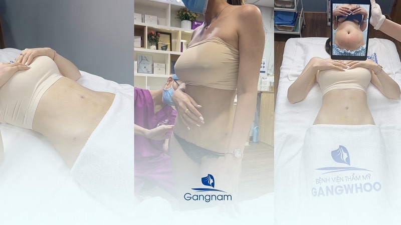 Quy trình hút mỡ bụng chuẩn y khoa diễn ra như thế nào? 7 Quy trình hút mỡ bụng