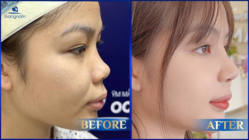 Tháo sụn mũi có trở lại bình thường không? 8 Tháo sụn mũi có trở lại bình thường không?