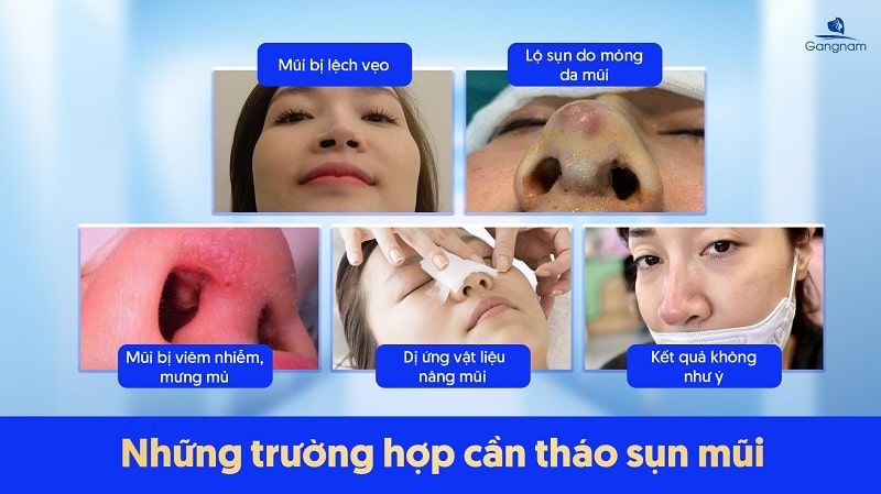 Tháo sụn mũi có trở lại bình thường không? 6 Tháo sụn mũi có trở lại bình thường không?