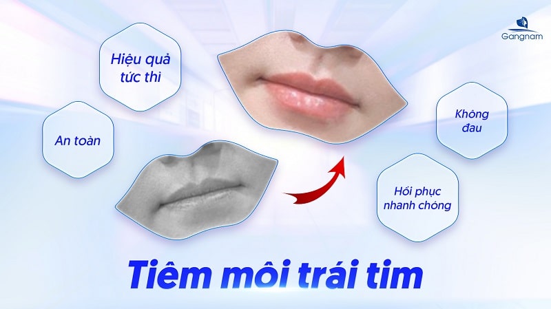 Tiêm môi trái tim bao nhiêu tiền? 6 Tiêm môi trái tim bao nhiêu tiền?