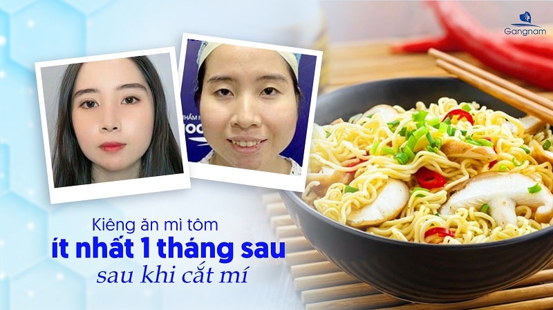 Cắt mí ăn mì tôm được không? 5 Cắt mí ăn mì tôm được không?