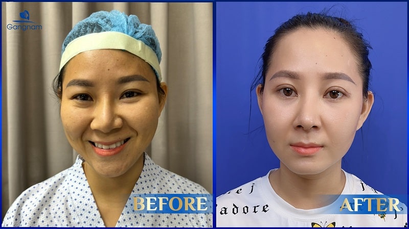 Cắt mí quá to có sửa được không? 6 Cắt mí quá to có sửa được không?