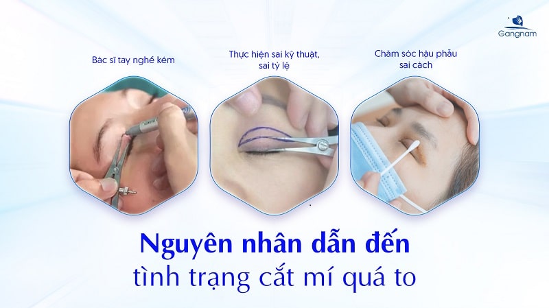 Cắt mí quá to có sửa được không? 5 Cắt mí quá to có sửa được không?