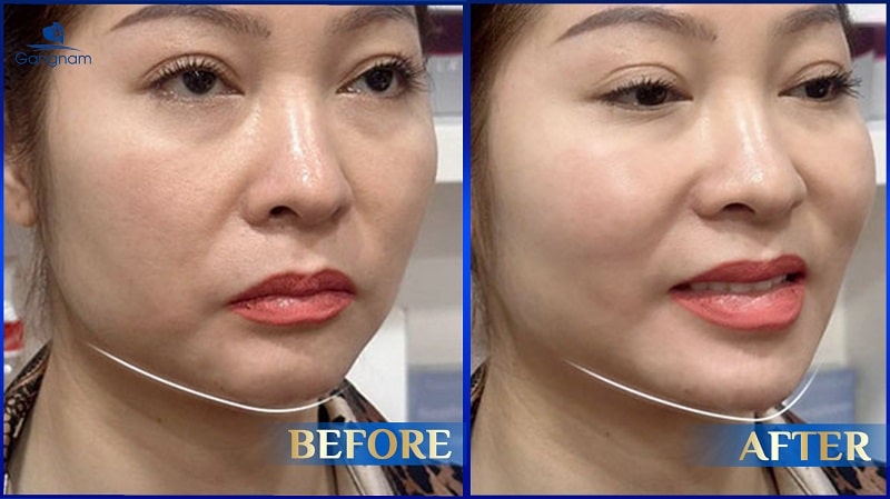 Độn cằm sụn tự thân có tốt không? 8 Độn cằm sụn tự thân