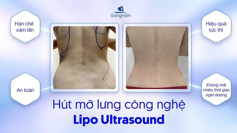 Hút mỡ lưng - Bí quyết sở hữu "thắt đáy lưng ong" chỉ sau 60 phút 5 Hút mỡ lưng