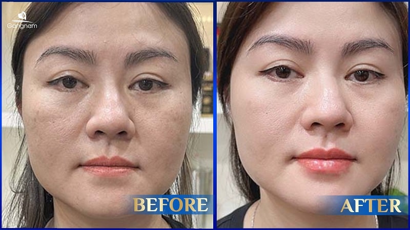 Môi tều là gì? Môi tều đẹp hay xấu? 8 Môi tều là gì?