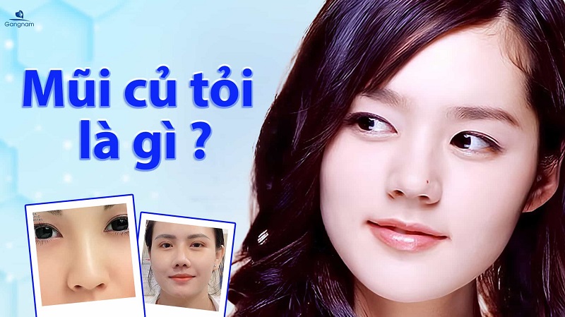 Mũi củ tỏi là gì? Ý nghĩa tướng số như thế nào? 5 Mũi củ tỏi là gì?