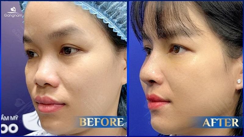 Mũi củ tỏi là gì? Ý nghĩa tướng số như thế nào? 8 Mũi củ tỏi là gì?