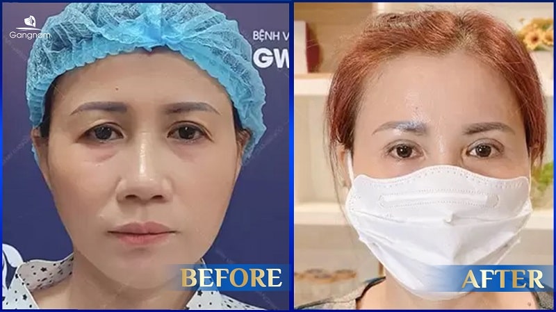 Nâng cung mày mấy ngày cắt chỉ? 8 Nâng cung mày mấy ngày cắt chỉ?