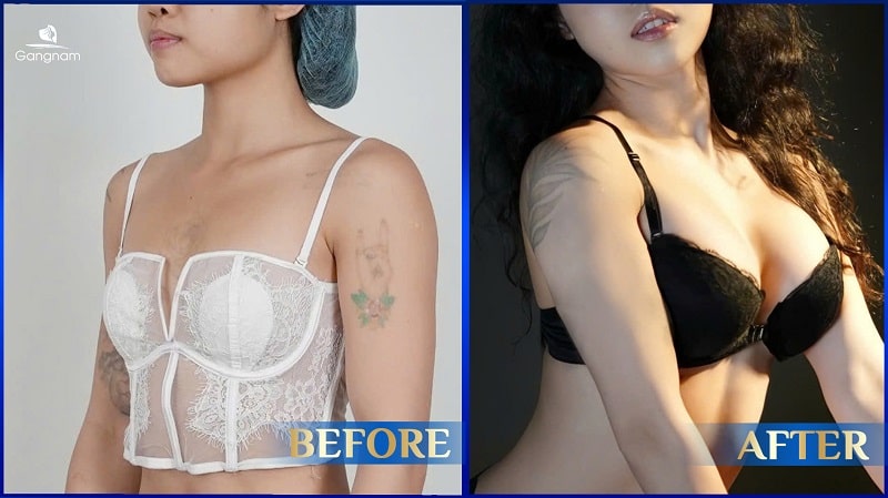 Nâng ngực túi tròn hay túi giọt nước? 6 Nâng ngực túi tròn hay túi giọt nước?