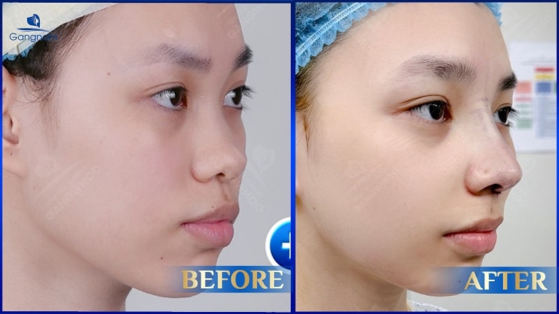 Tìm hiểu những dáng mũi không nên sửa 6 Những dáng mũi không nên sửa