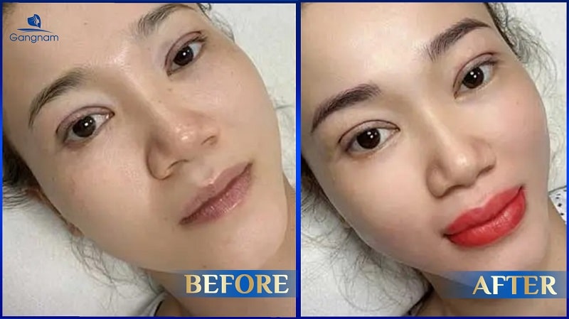 Môi bị nhăn sau khi phun - Nguyên nhân và cách khắc phục hiệu quả 8 Phun môi xong bị khô