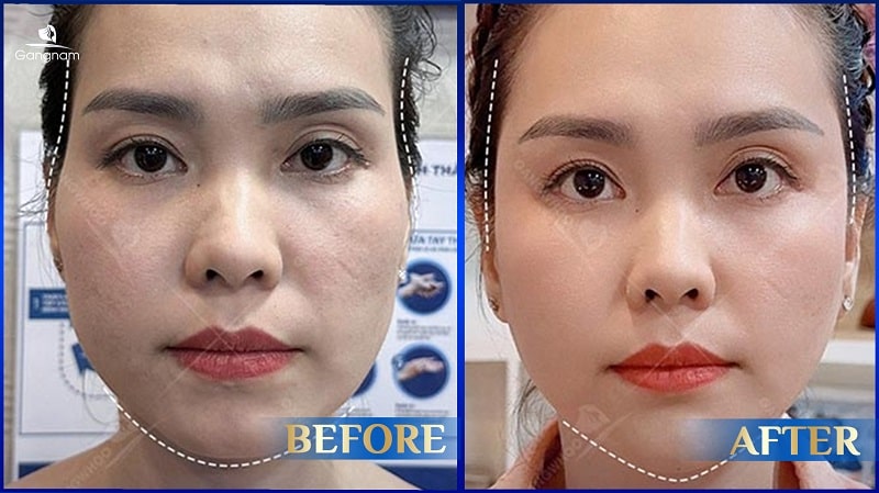 Tiêm Filler xong bị ngứa có sao không? 8 Tiêm Filler xong bị ngứa
