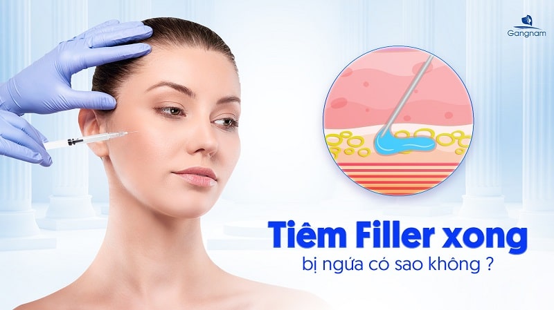Tiêm Filler xong bị ngứa có sao không? 5 Tiêm Filler xong bị ngứa