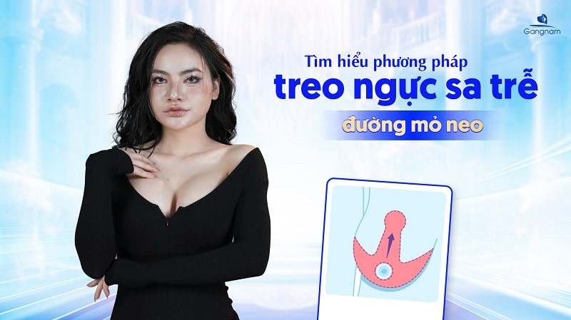 Tìm hiểu phương pháp treo ngực sa trễ đường mỏ neo 5 Treo ngực sa trễ đường mỏ neo