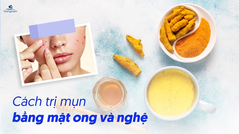 Top 8 cách trị mụn bằng mật ong tại nhà 6 Cách trị mụn bằng mật ong