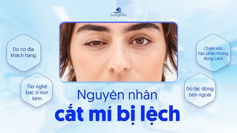 Cắt mí bên to bên nhỏ phải làm sao? 6 Cắt mí bên to bên nhỏ