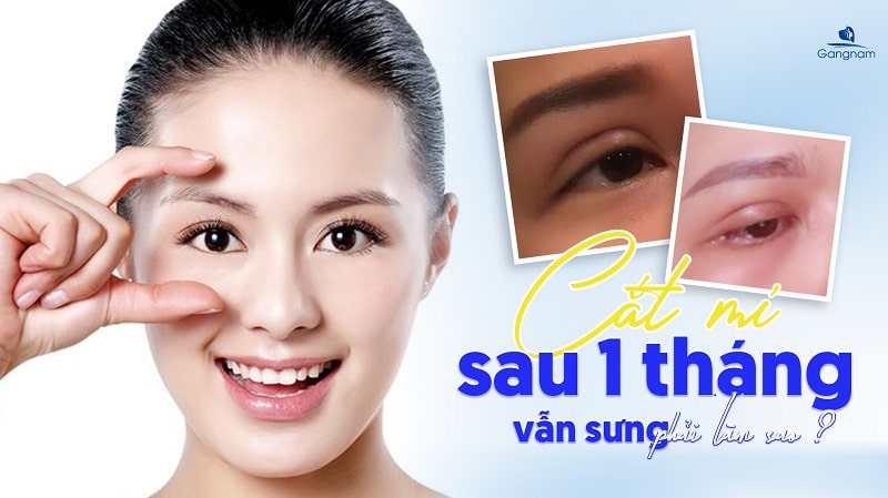 Cắt mí sau 1 tháng vẫn sưng phải làm sao? 5 Cắt mí sau 1 tháng vẫn sưng