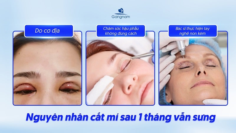 Cắt mí sau 1 tháng vẫn sưng phải làm sao? 6 Cắt mí sau 1 tháng vẫn sưng