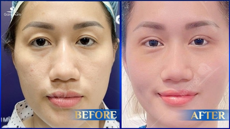 Cắt mí dưới bị lật phải làm sao? 8 Cắt mí sau 1 tháng vẫn sưng
