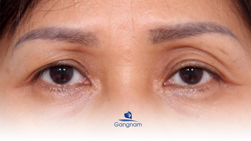 Hốc mắt sâu - Nguyên nhân và cách khắc phục 6 Hốc mắt sâu
