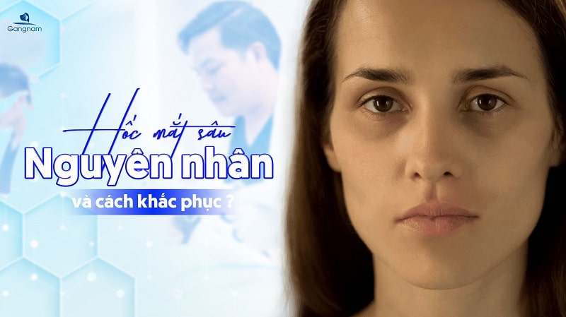 Hốc mắt sâu - Nguyên nhân và cách khắc phục 5 Hốc mắt sâu
