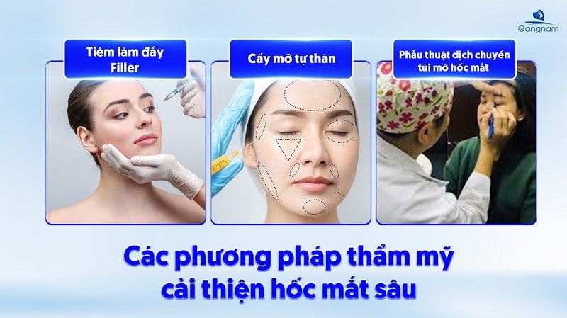 Hốc mắt sâu - Nguyên nhân và cách khắc phục 8 Hốc mắt sâu