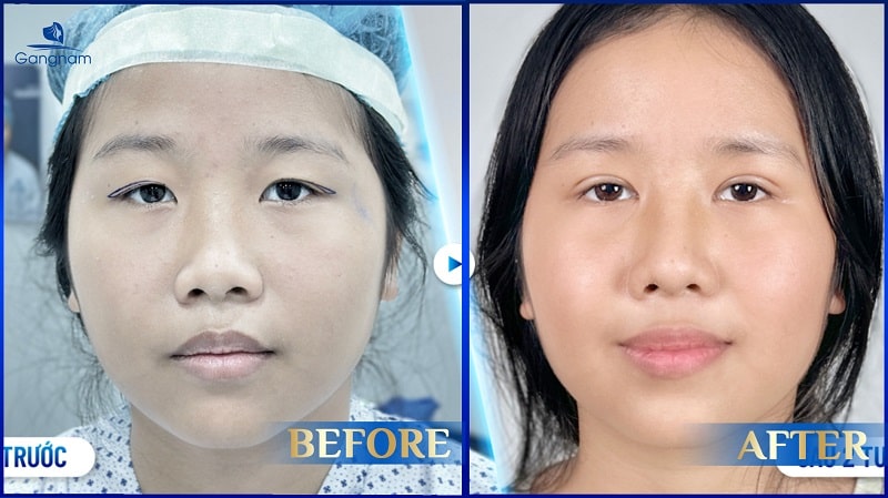 Mắt mí lót đẹp hay xấu? Cách khắc phục hiệu quả 8 Mắt mí lót