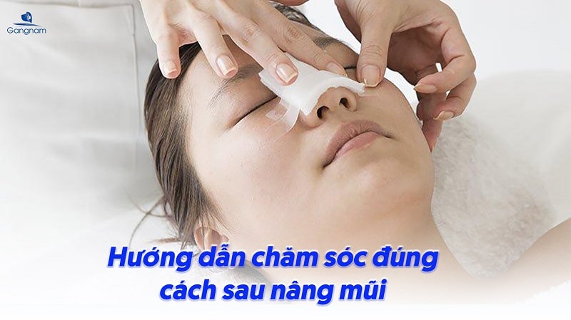 Nâng mũi sau 1 tháng đã ổn định chưa? 5 Nâng mũi sau 1 tháng