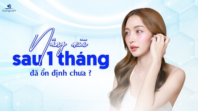 Nâng mũi sau 1 tháng đã ổn định chưa? 4 Nâng mũi sau 1 tháng