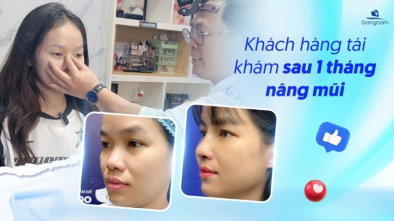 Nâng mũi sau 1 tháng đã ổn định chưa? 6 Nâng mũi sau 1 tháng